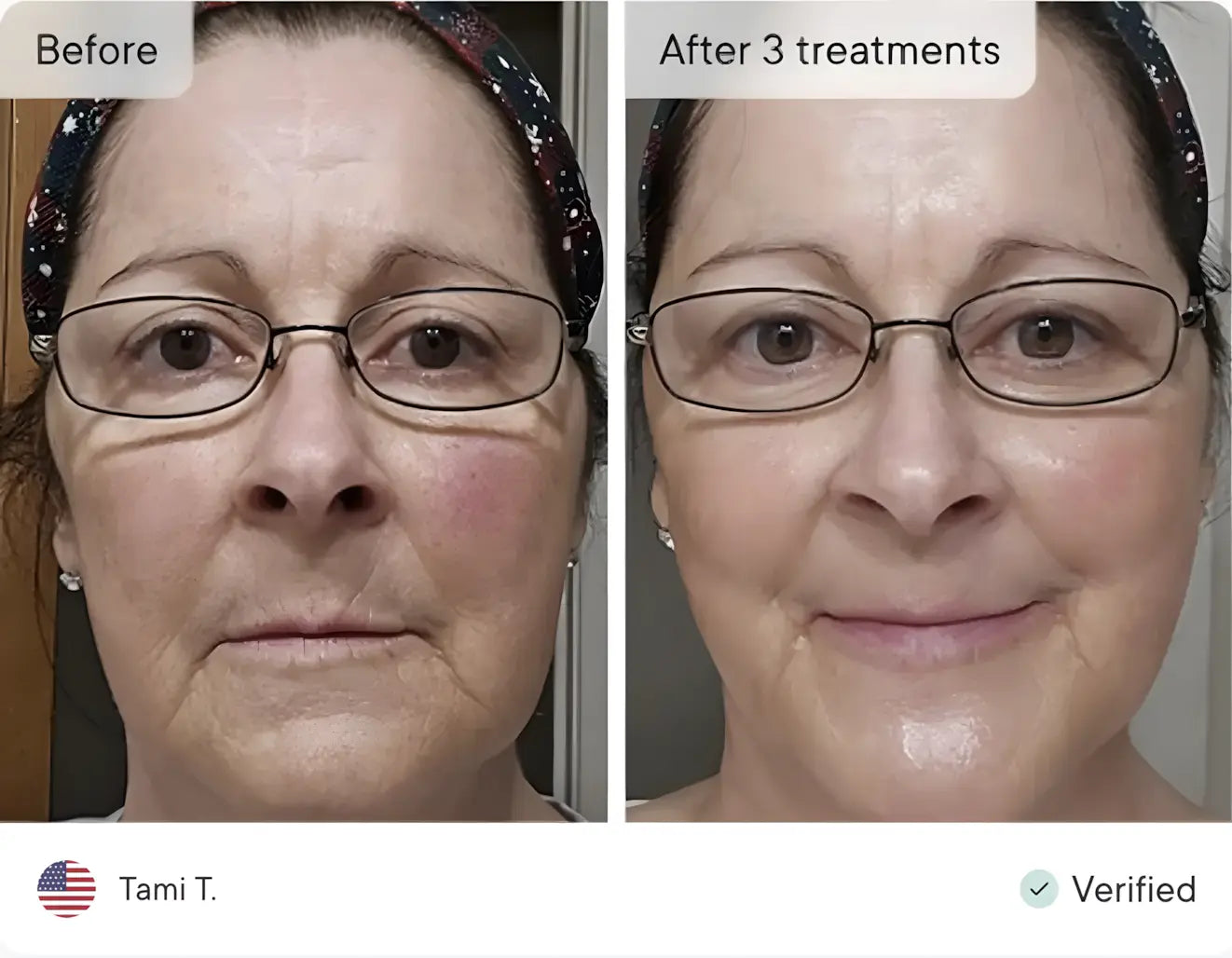 Micro-Infusion Lift Pro + 1 Sérum extra